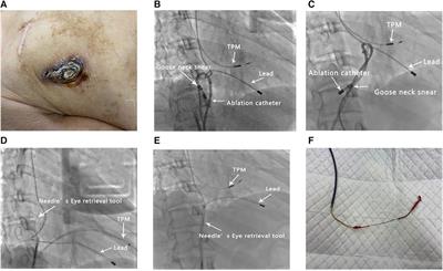 Case Report: Enhancing lead extraction techniques: a novel approach using a loop formed by an ablation catheter and a gooseneck snare